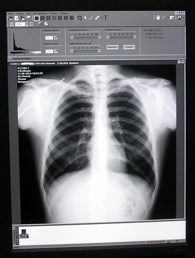 Онко Вики — Флюорография и рентгенография в диагностике рака легкого