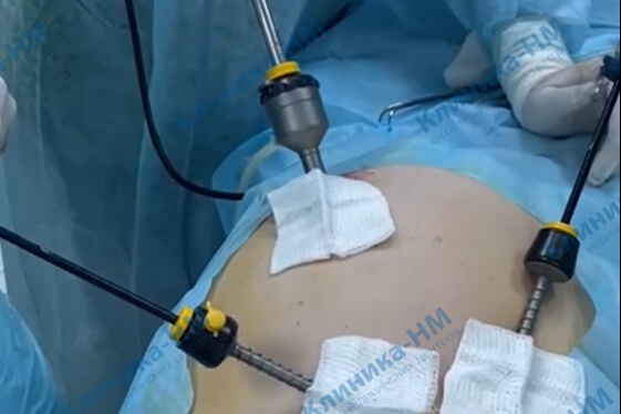 Смотрите новое видео о лапароскопической операции в Клиника-НМ